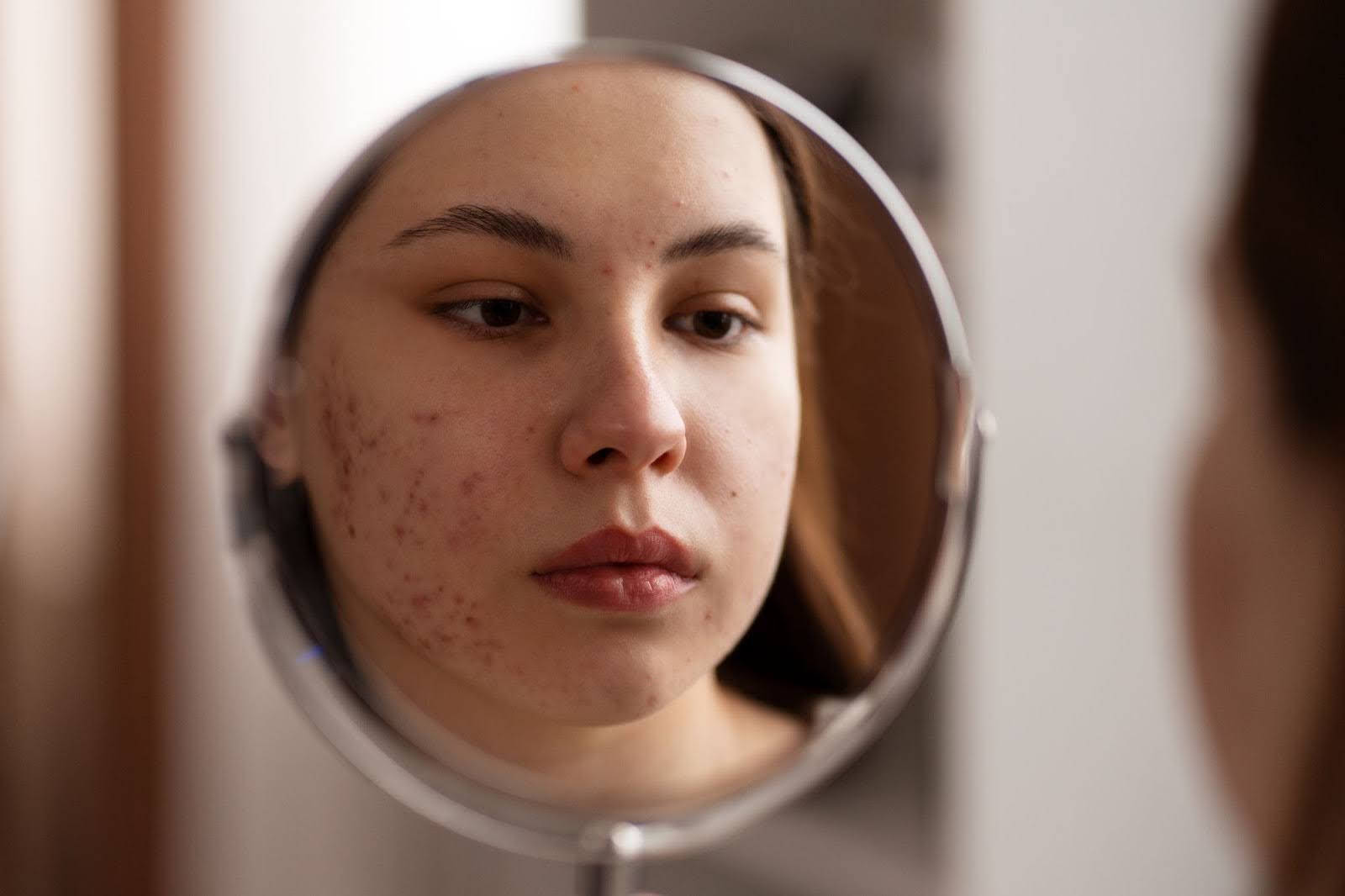 Fungal Acne vs Closed Comedones: How to Tell Them Apart