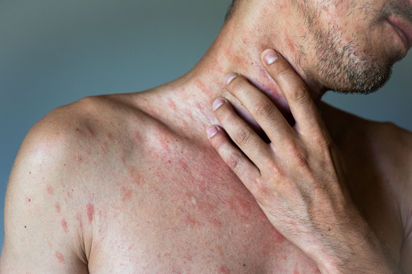 What Causes a Rash on the Stomach?