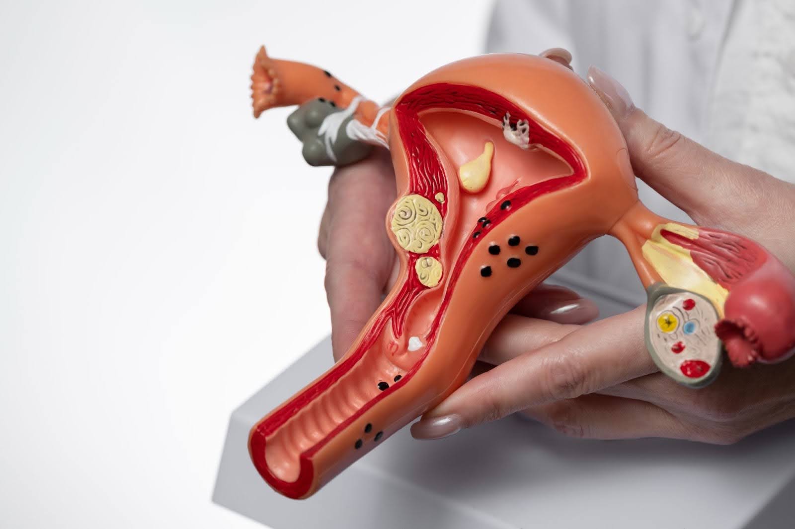 How Big Is Too Big? Dangerous Size for an Ovarian Cyst