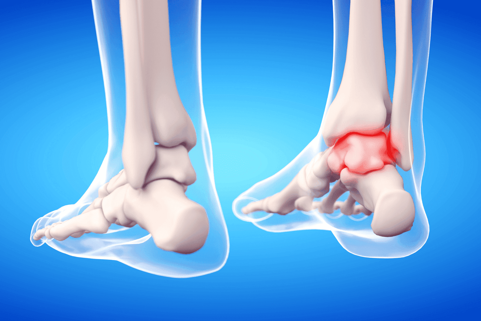 3D medical illustration of human ankle bones, highlighting joint inflammation in red