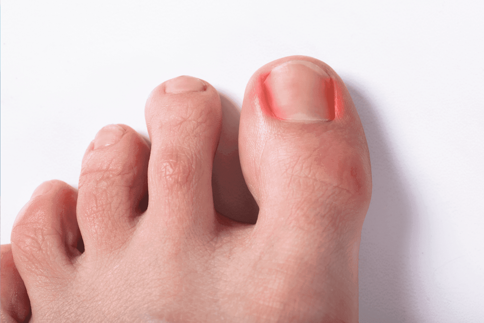 A close-up of a person’s foot showing an inflamed, red area around the edge of the big toenail, suggesting a possible ingrown toenail or infection.