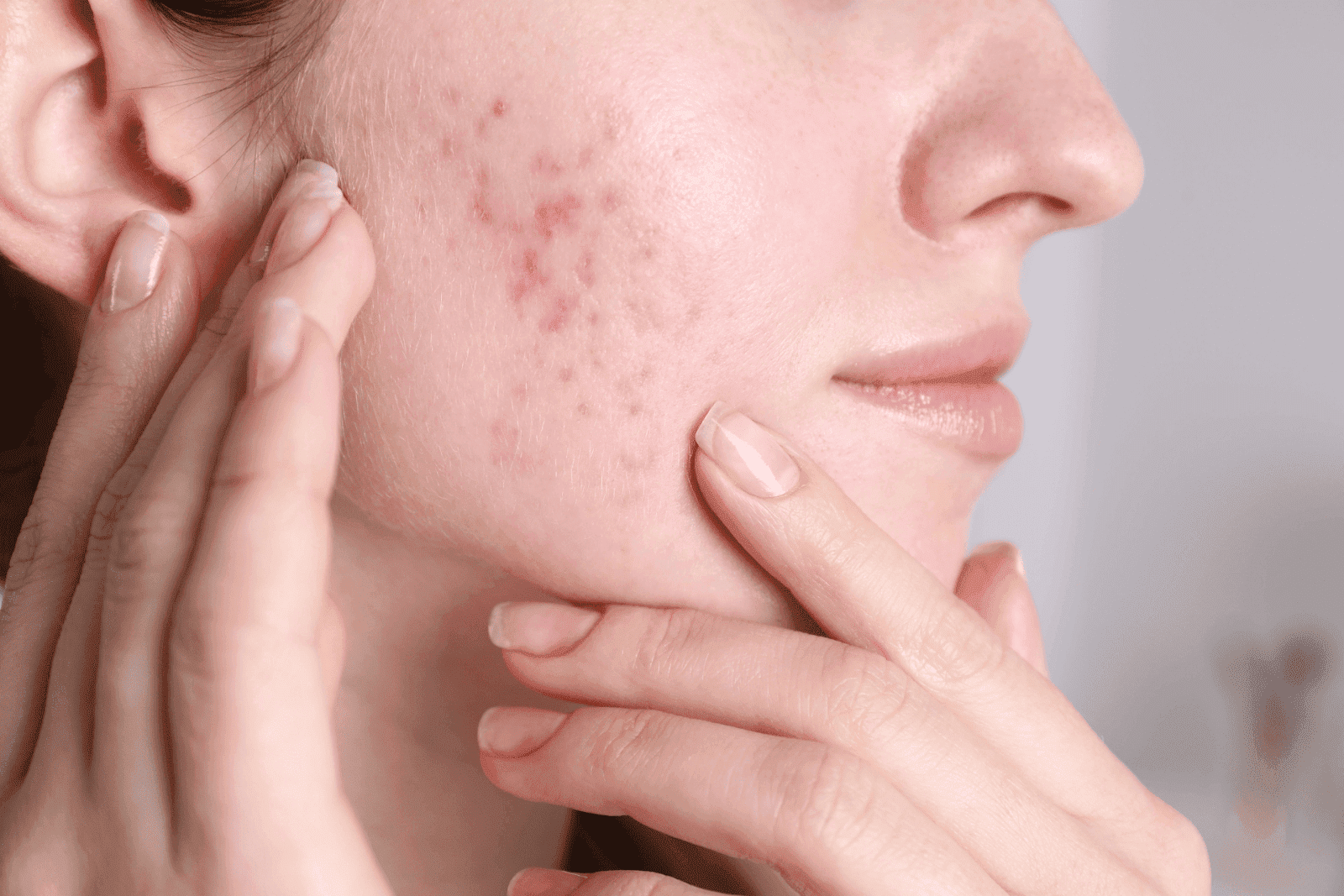 A close-up of a person touching their cheek, which shows red acne or skin irritation.