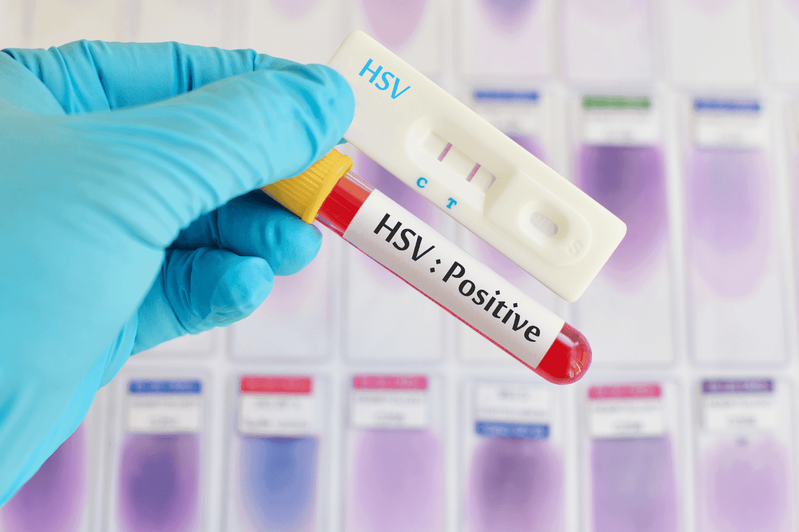 A gloved hand holding a blood sample tube and test device labeled HSV: Positive.
