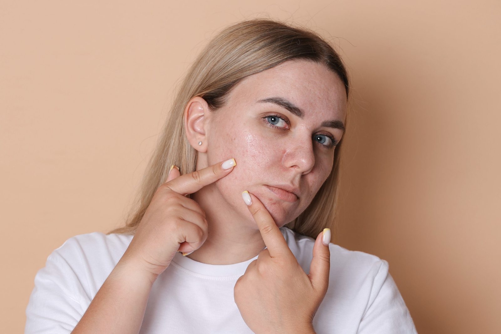 A woman touching her cheek and chin while examining redness or acne on her face.