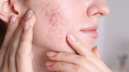 Acne marks on a woman’s face