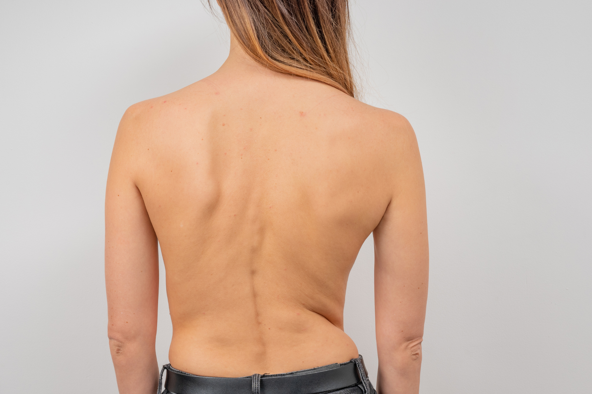 Back view of a woman showing uneven shoulders and possible spinal curvature