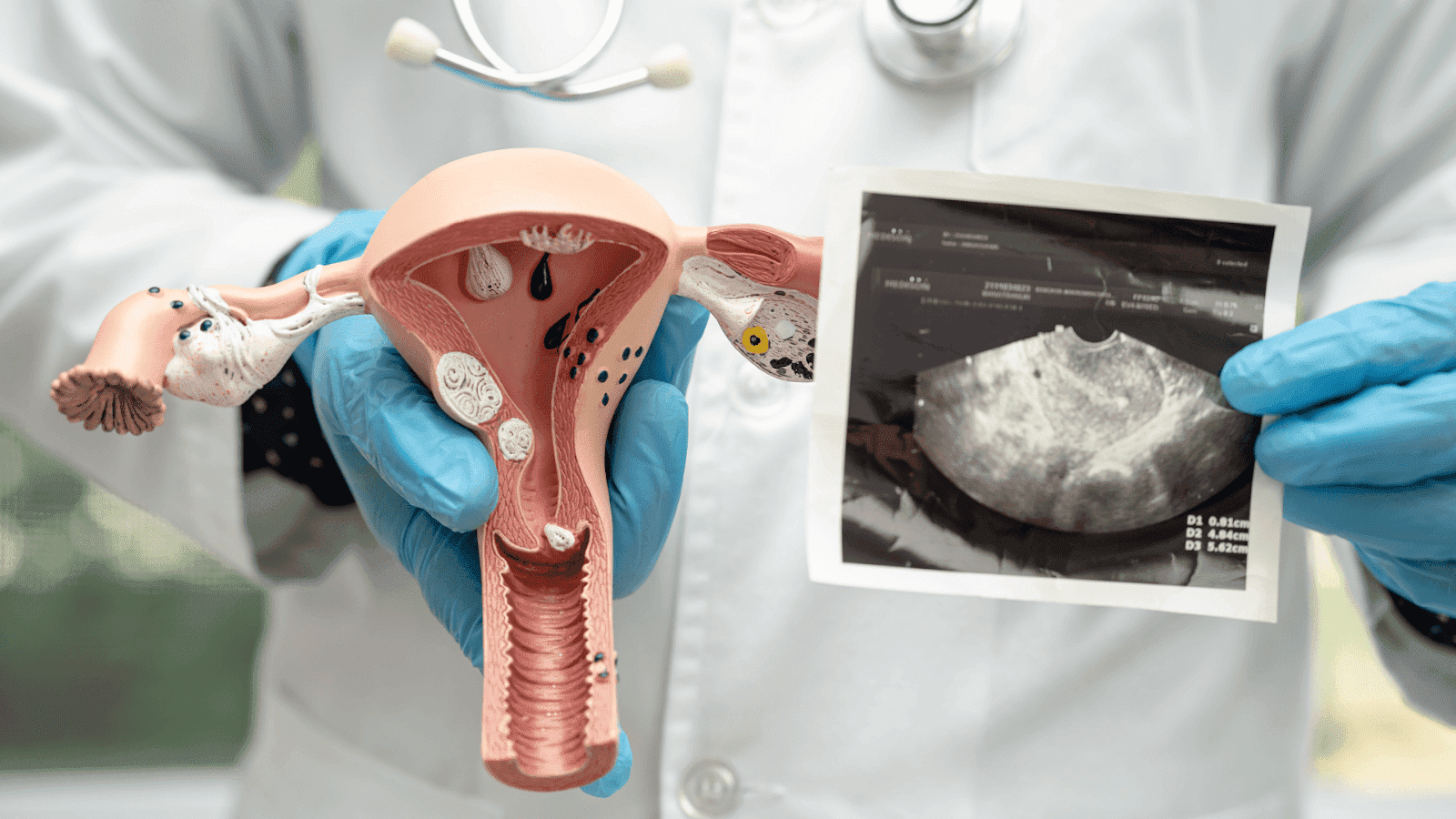 Suspecting PCOS? Here's a Quick Way to Check Your Symptoms