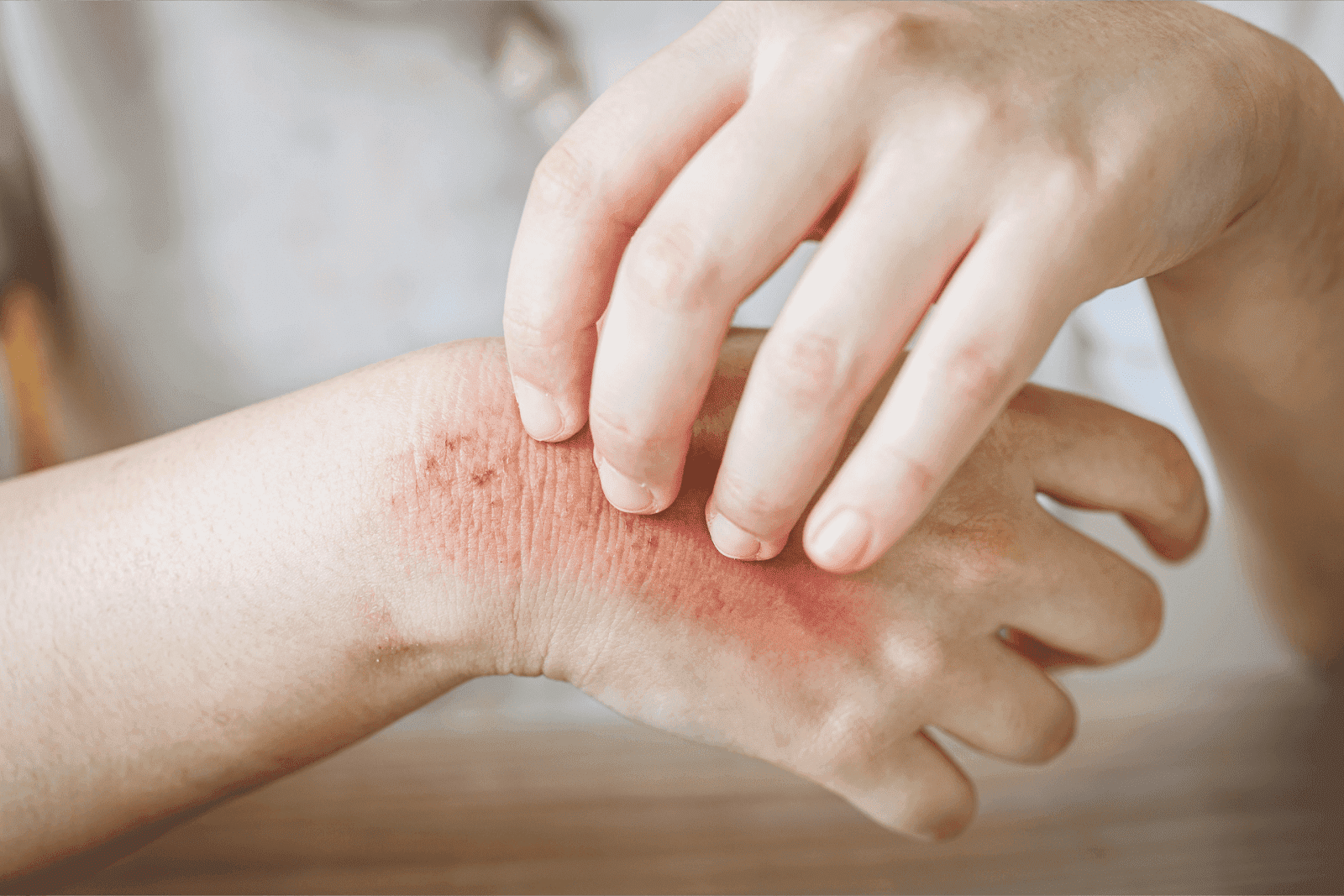 Got a Rash? Here's How to Tell What’s Causing It