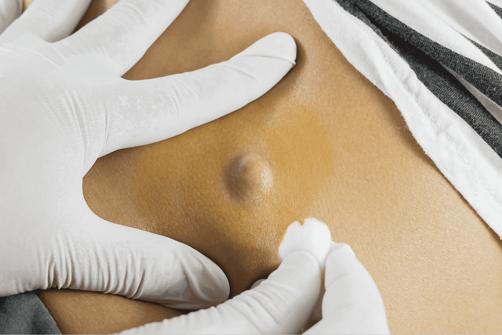 Close-up of a healthcare professional’s gloved hands examining a raised lump under the skin of a patient’s abdomen, with the area disinfected using antiseptic.