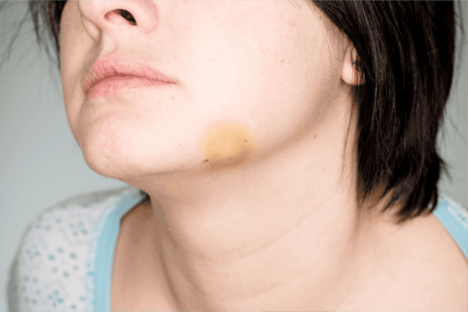 Got a Bruise on Your Chin? Here's When to Pay Attention