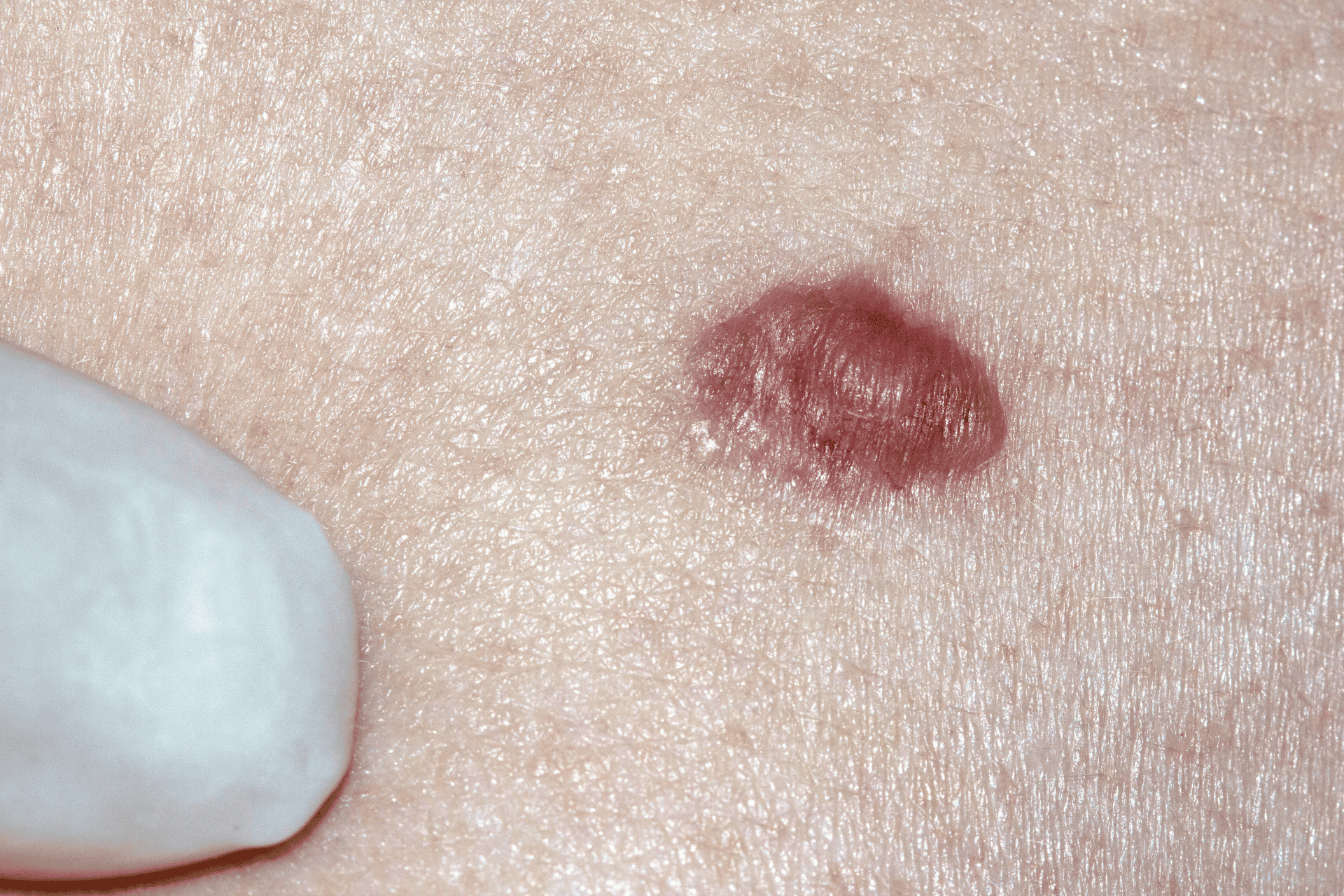 Close-up of a raised, reddish skin lesion on human skin, with a gloved finger pointing nearby for examination