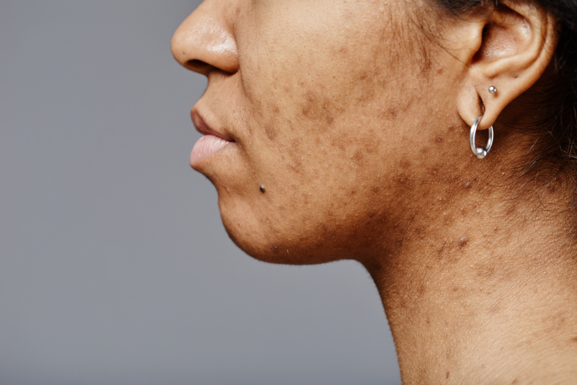Close-up of a woman’s cheek and jaw showing dark spots and hyperpigmentation