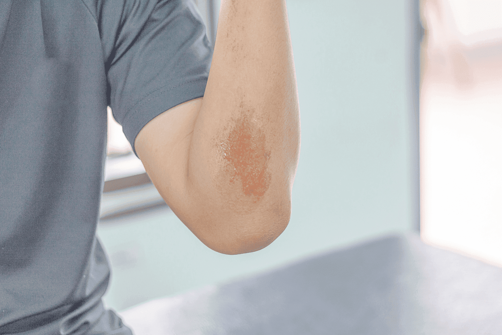 How to Treat Road Rash Quickly and Safely