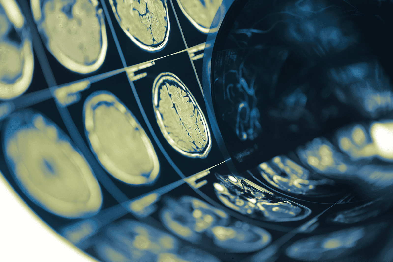 Worried About a Stroke? Here’s How to Spot the Signs