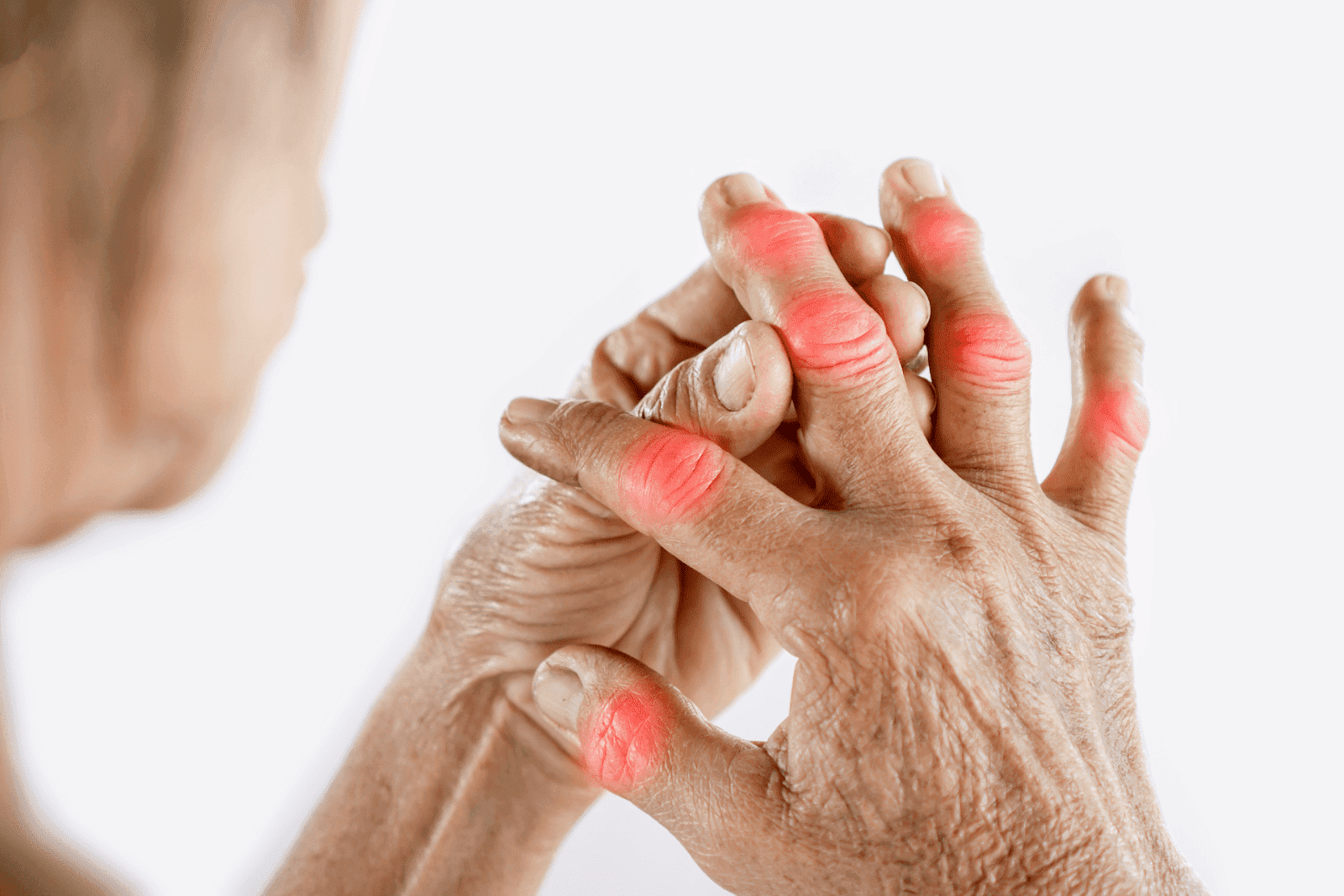 Close-up of senior hands with red, swollen finger joints, showing symptoms of arthritis or joint inflammation.