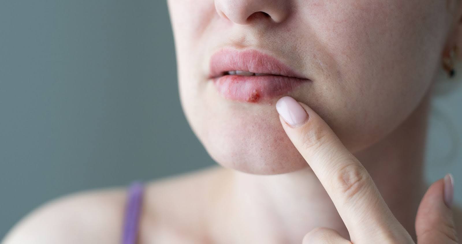 Herpes on Lips