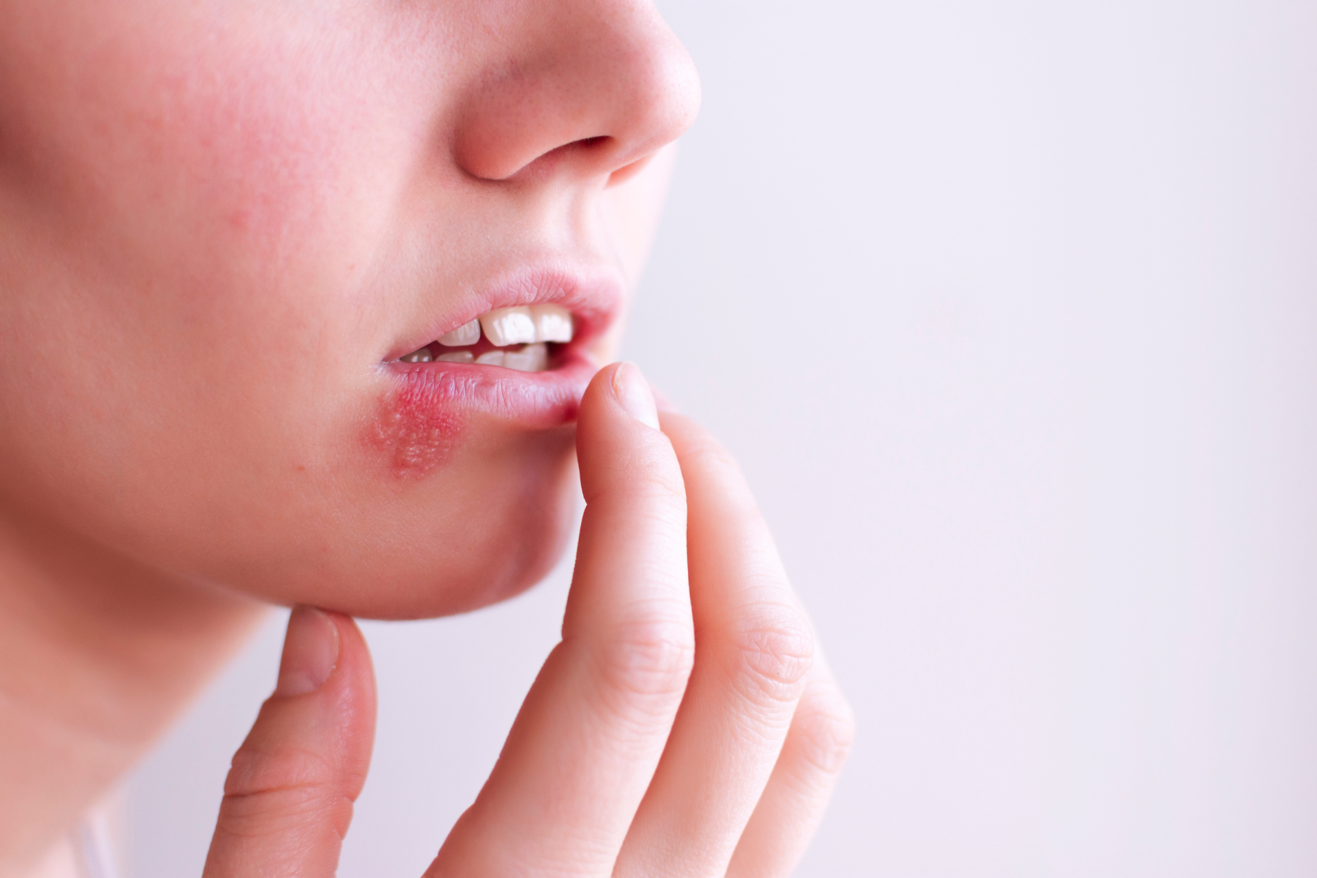 Close-up of the lower face showing a red, blistering cold sore at the corner of the lower lip as a finger touches nearby