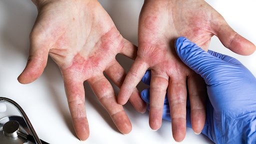 Person with eczema on their hands.