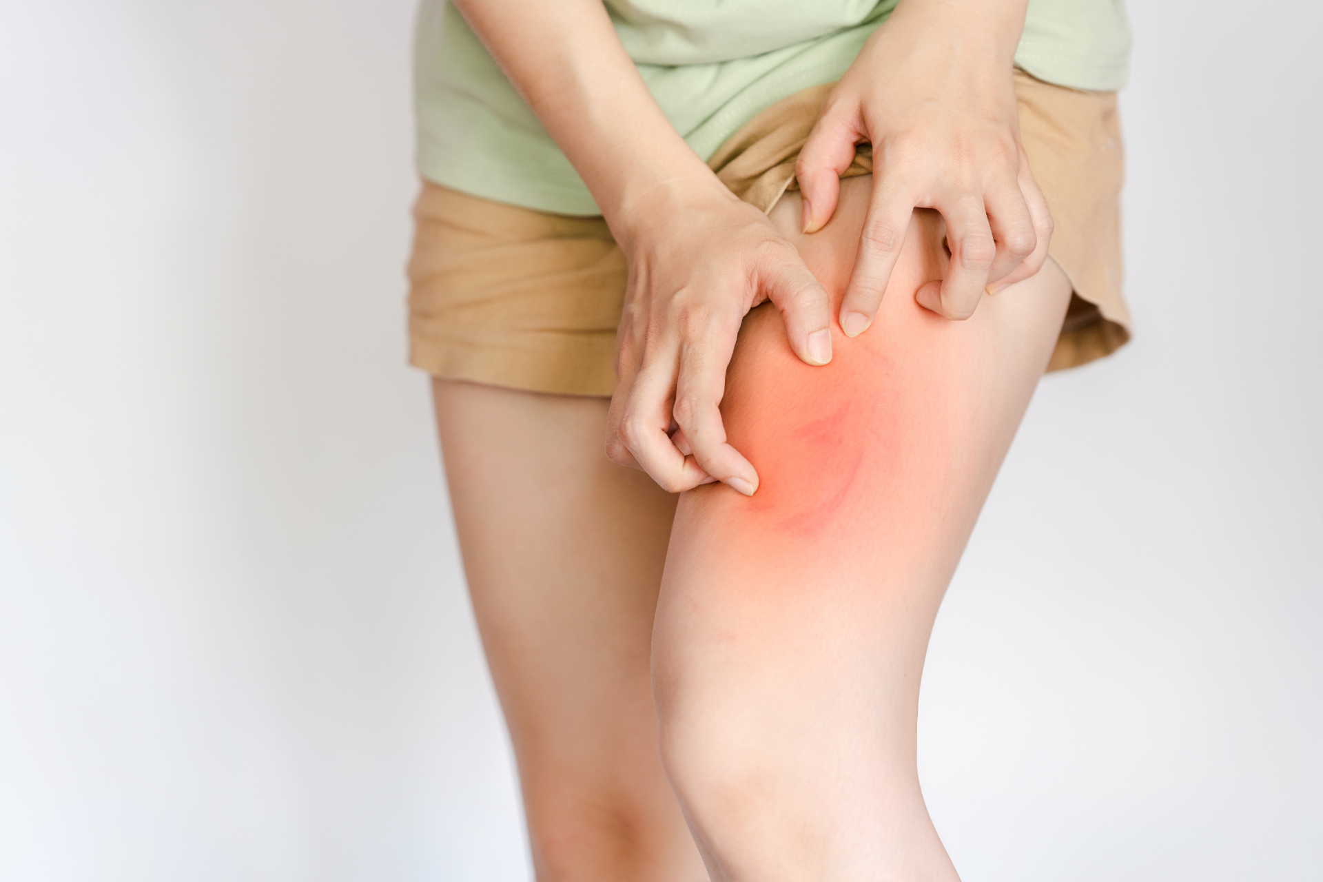 Person scratching a red, irritated rash on their thigh