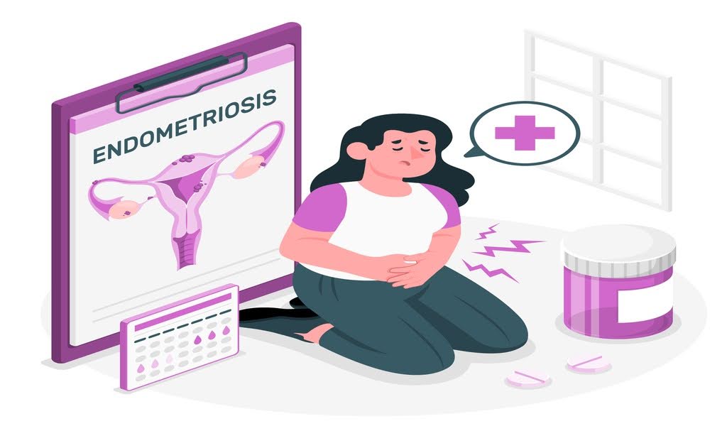 This illustration depicts endometriosis
