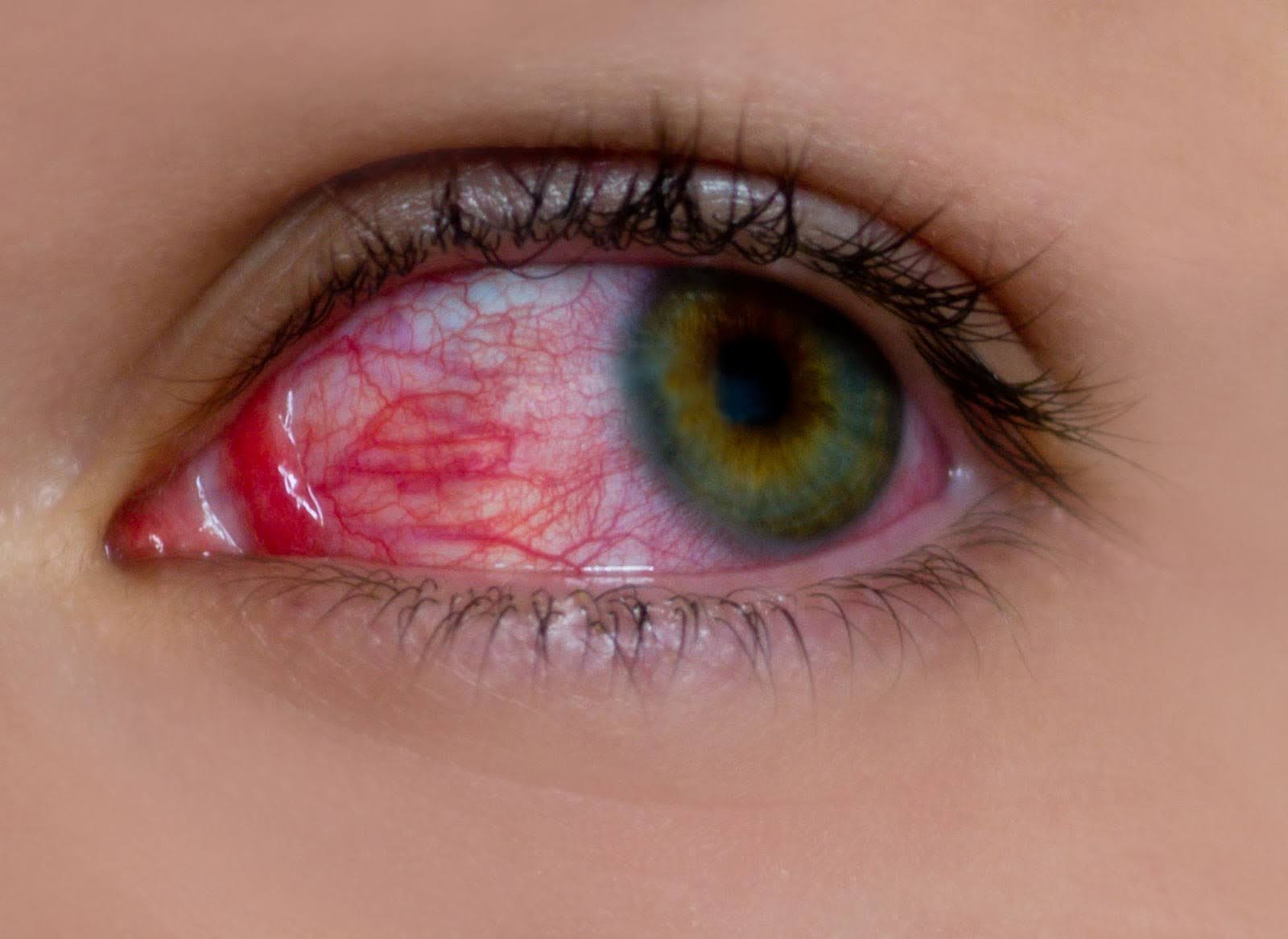 How to Heal a Broken Blood Vessel in Your Eye Fast