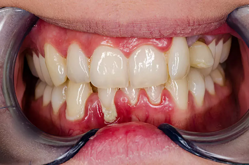 How to Cure Gingivitis in Just One Week