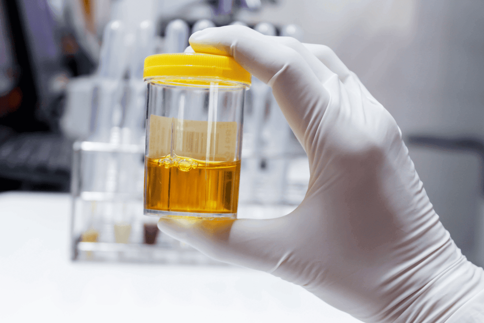Gloved hand holding a urine sample container