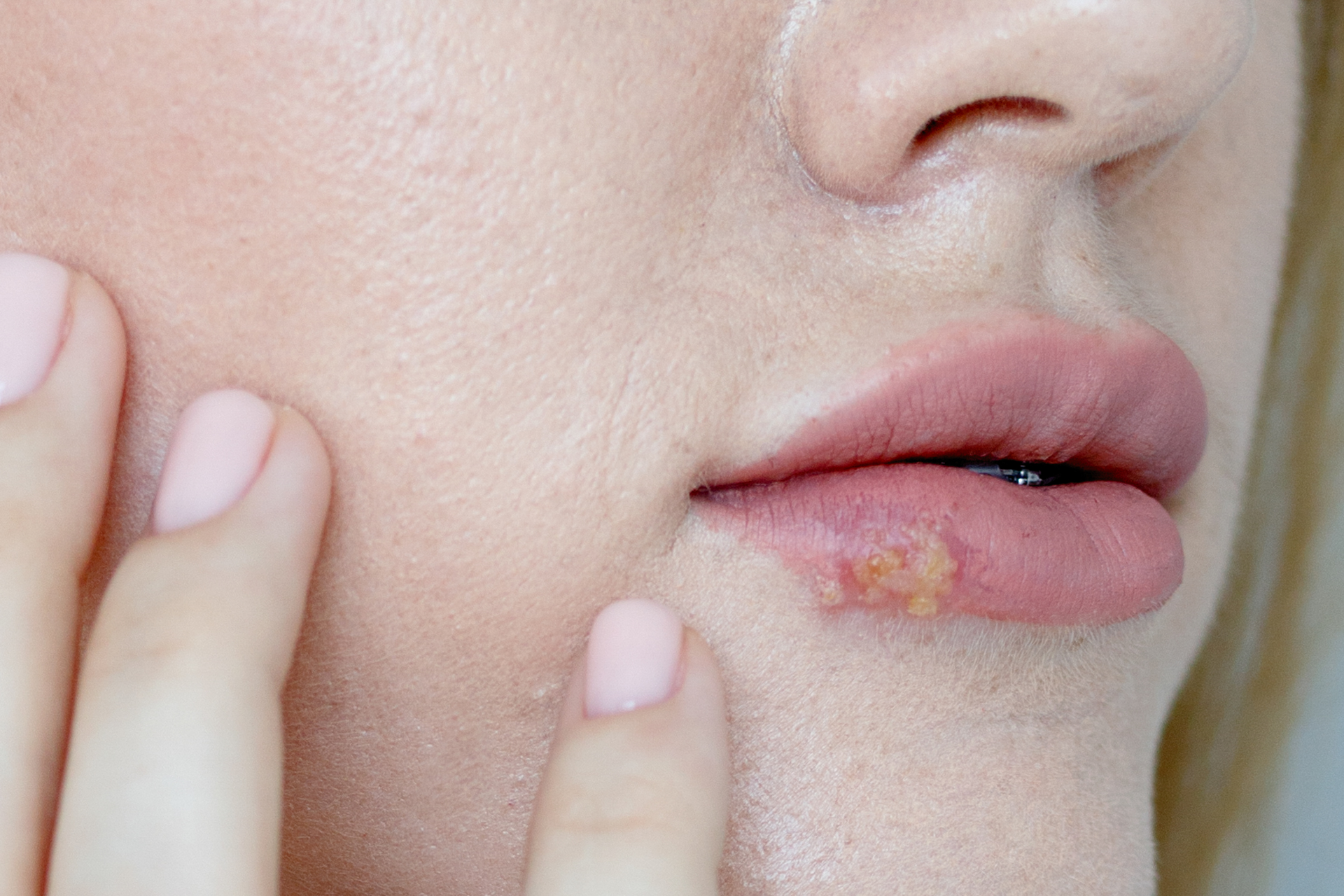 Close-up of a person with a cold sore on their lower lip