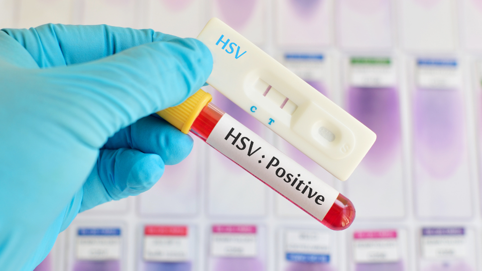 Can Urgent Care Test for Herpes?
