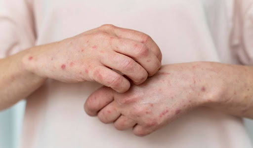 Irritated skin on the hand caused by insect bites.
