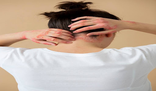 Folliculitis vs Herpes: What’s Causing the Rash?