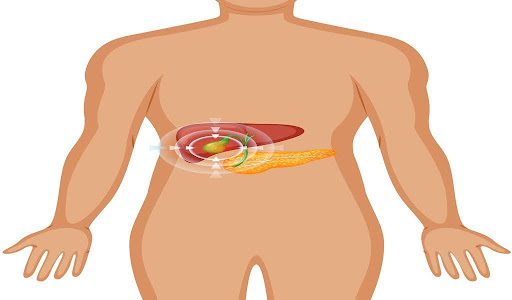 Gallstones vs Kidney Stones: What’s the Difference?