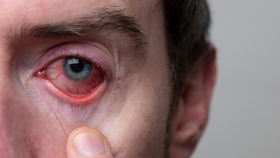 Should I Go to Urgent Care for Pink Eye?
