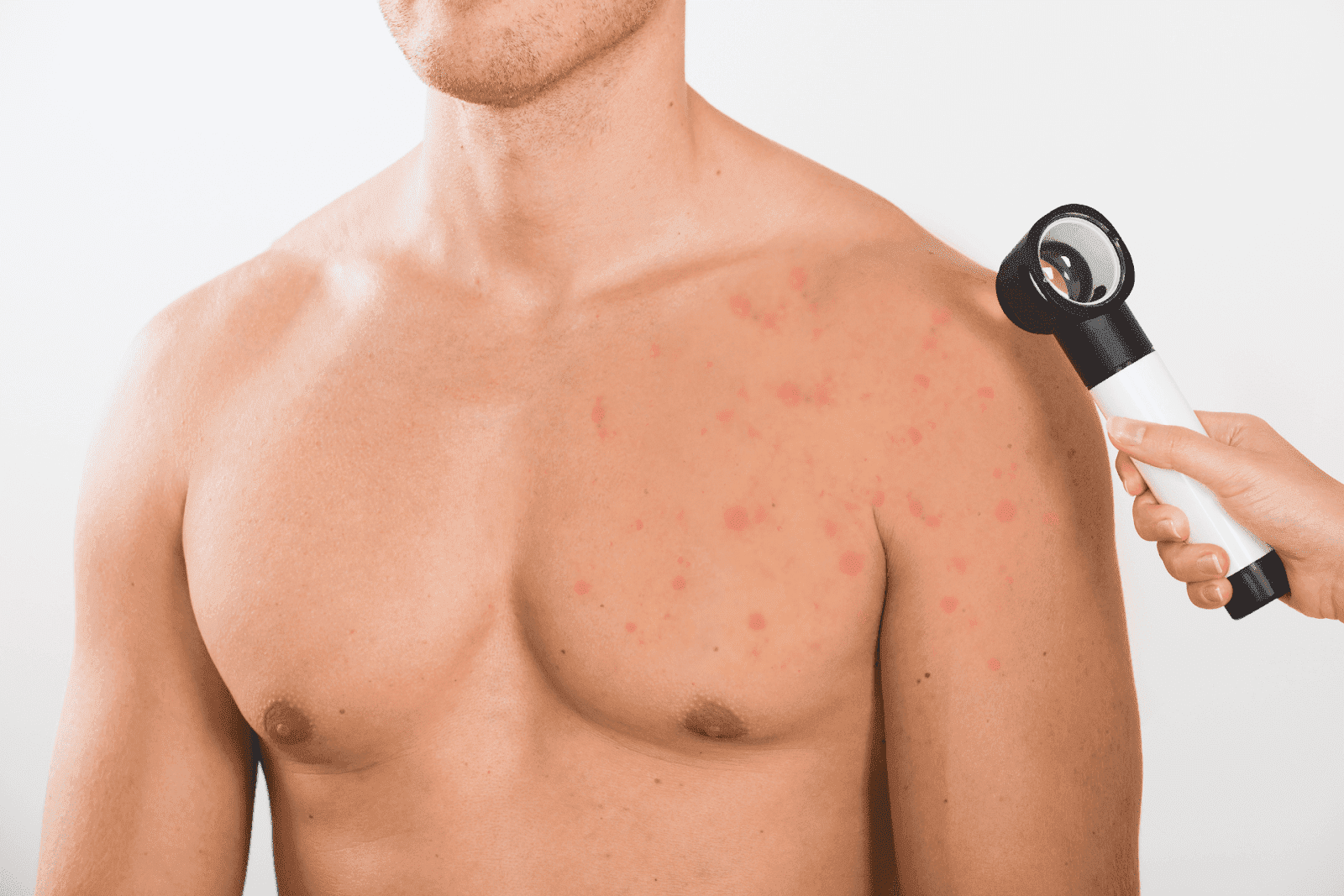 Man’s chest and shoulder with acne being examined with a magnifying tool