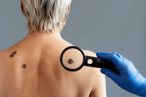 Melanoma through magnifying glass