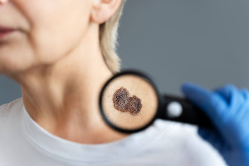 A magnifying glass showing skin spots