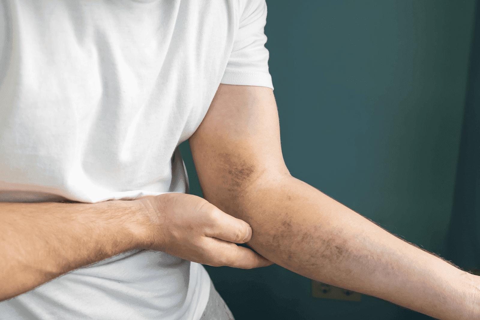 Bruising Too Easily? Here's What Your Body Might Be Telling You