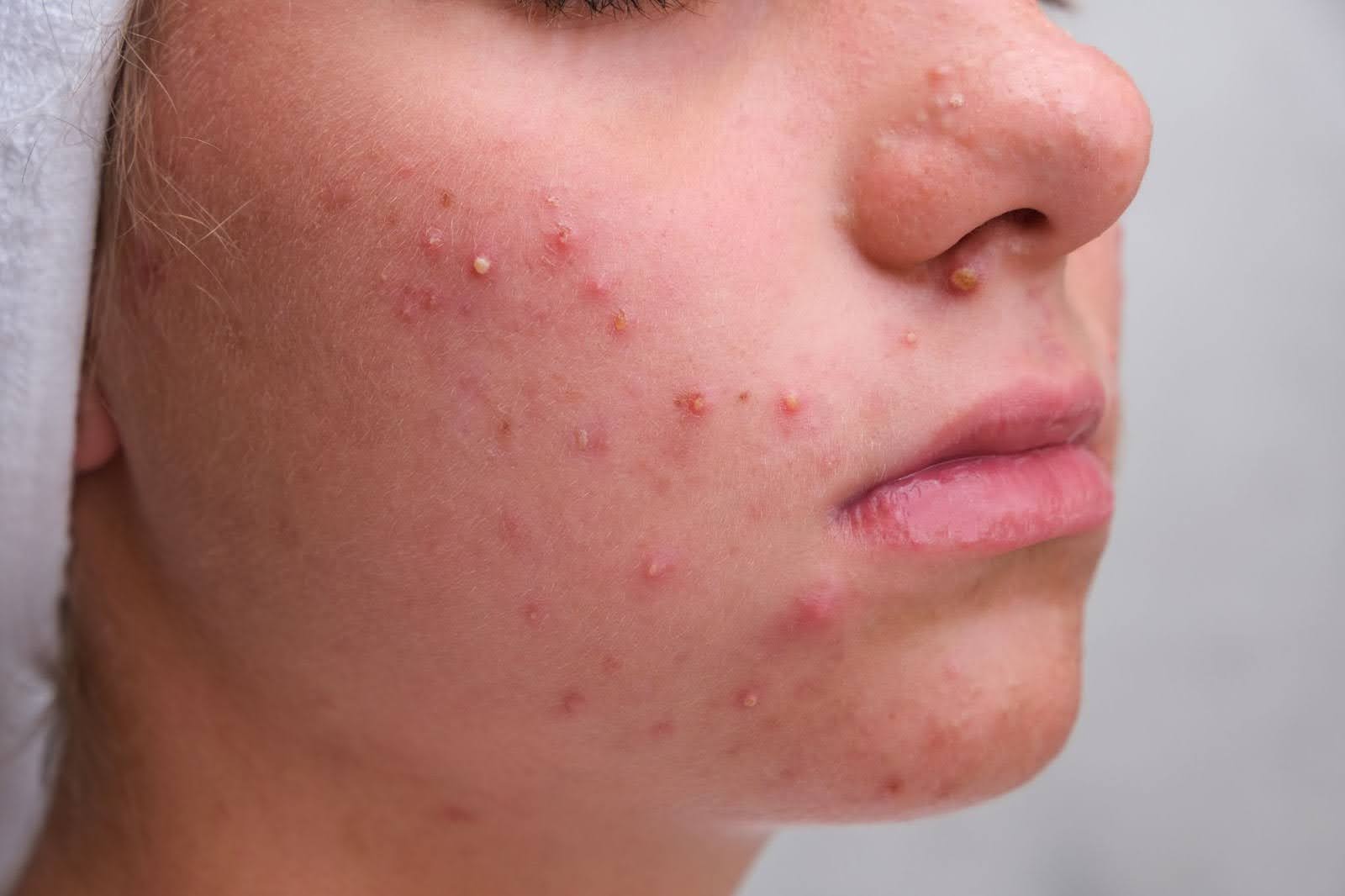 Pimples on Face