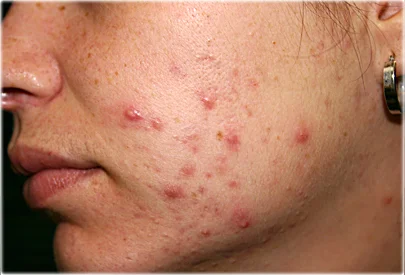 pimples and redness on the face