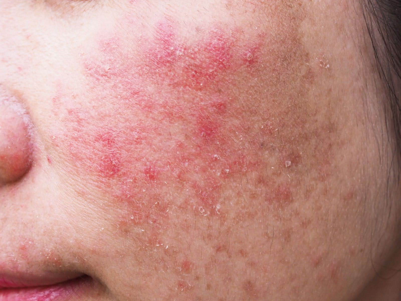 Acne on Face
