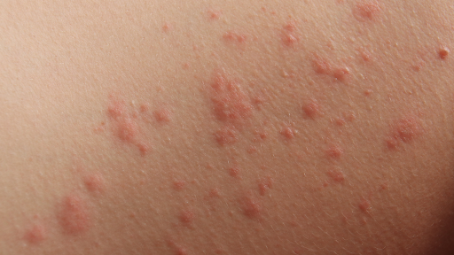 Skin with red bumps due to dermatitis.