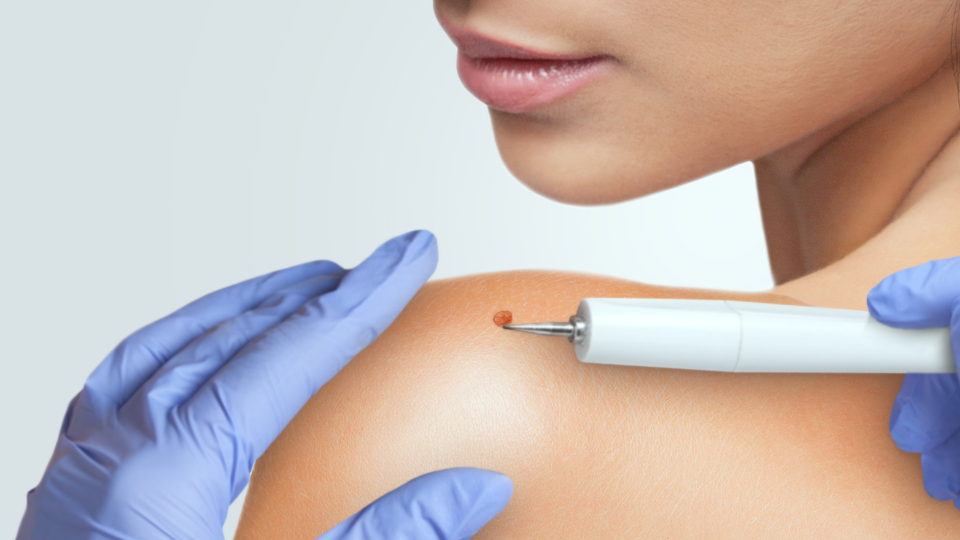 Doctor removing wart from shoulder of a woman
