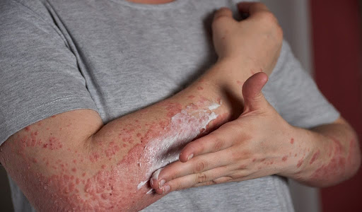 Man applying anti-bacterial cream on his affected hand.