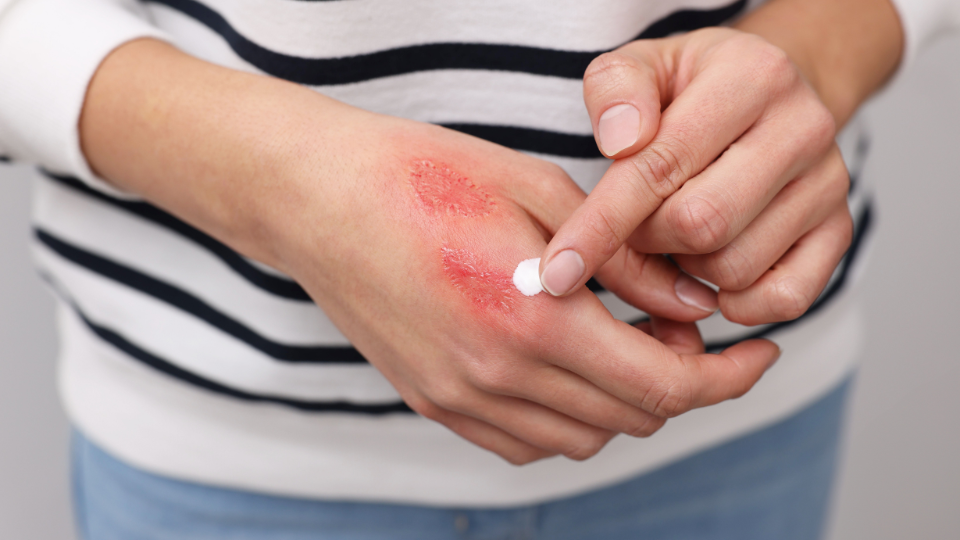 Women applying cream to a burn on her hand