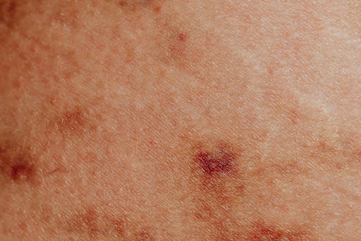Skin reaction.