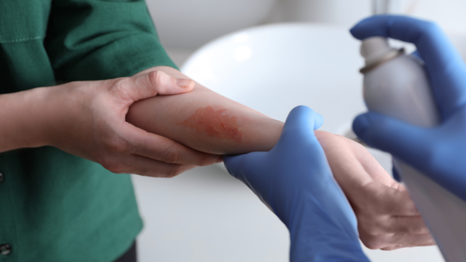Doctor spraying burn on patient's arm