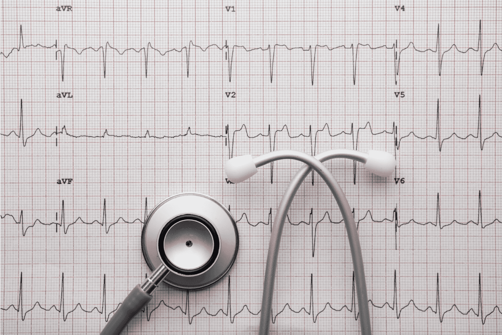 Stethoscope placed on an ECG printout showing heart rhythm patterns.