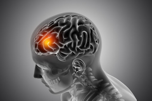 A Brain suffering from a Stroke
