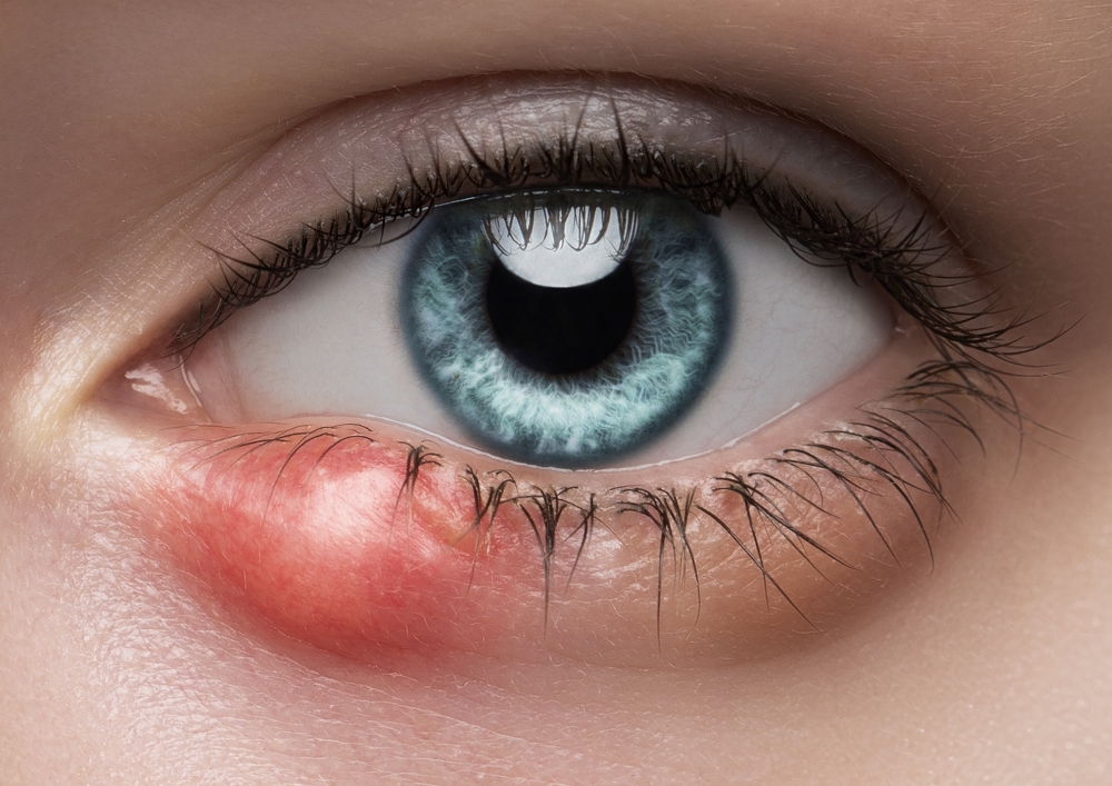 Example of Stye