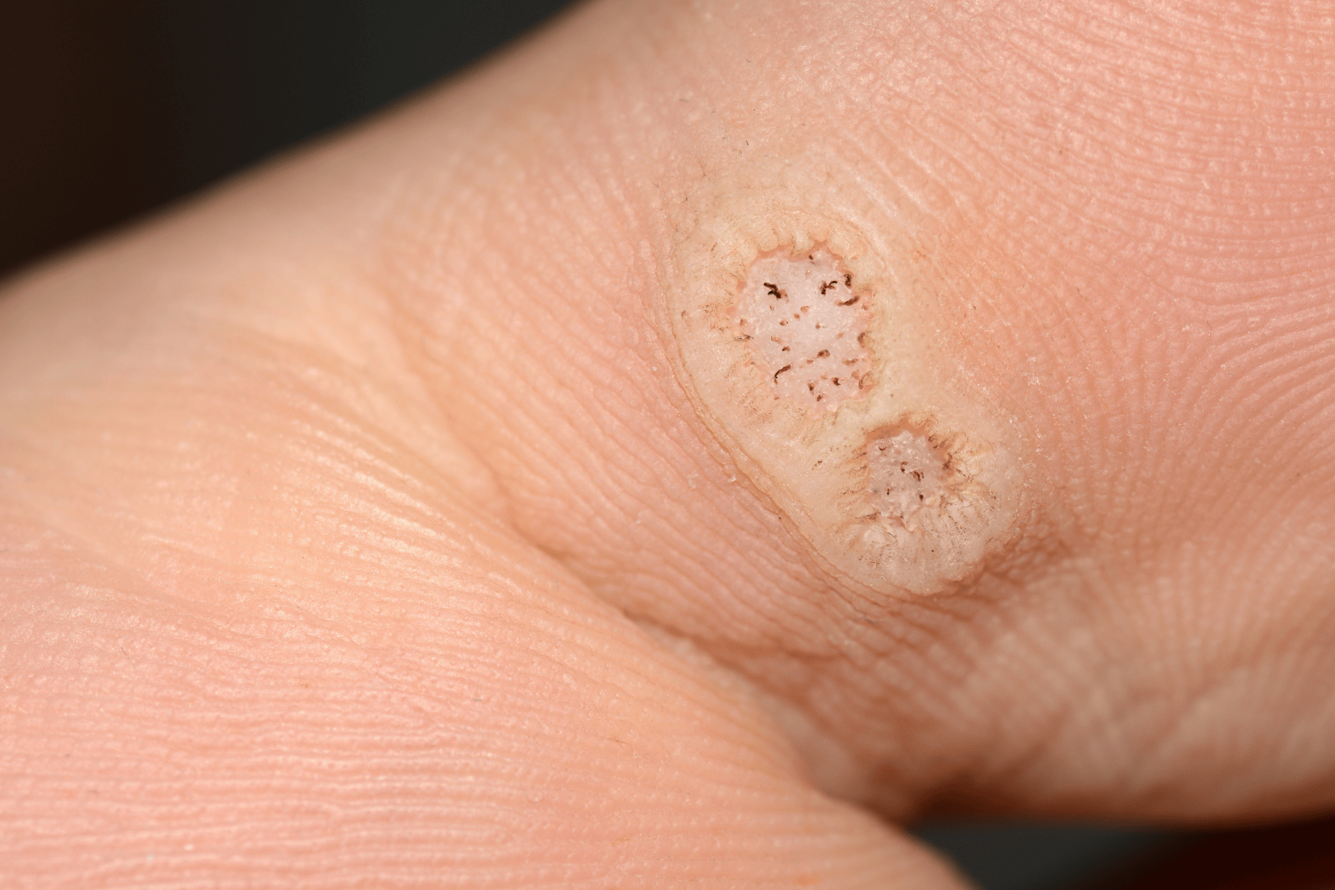 Closeup of two plantar warts on a toe